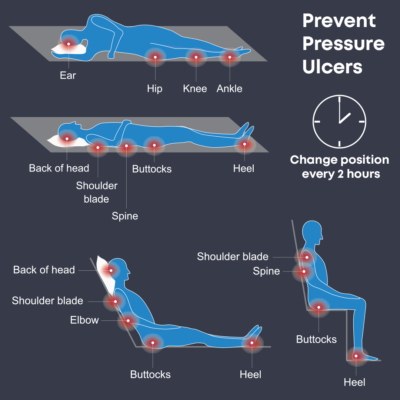 Pressure Ulcers - Alzheimer's Los Angeles