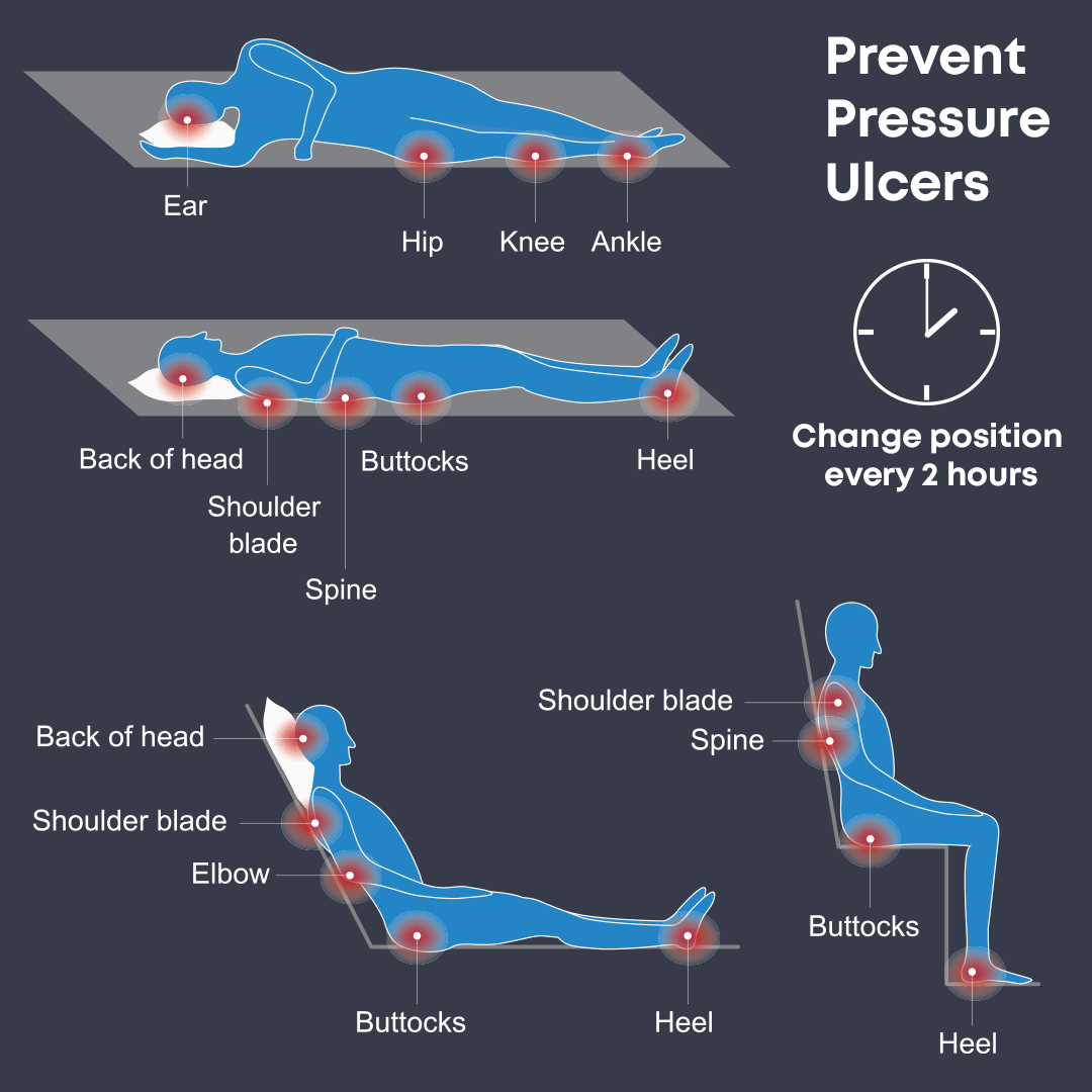 Preventing pressure ulcers